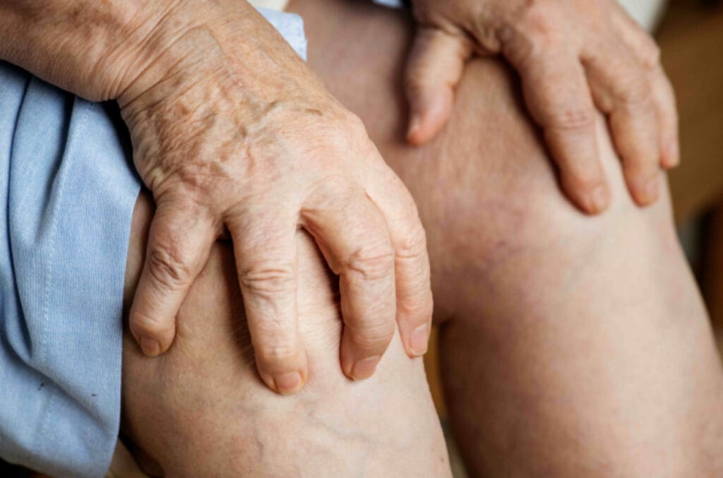 Silenciosa, trombose pode gerar problemas graves de saúde