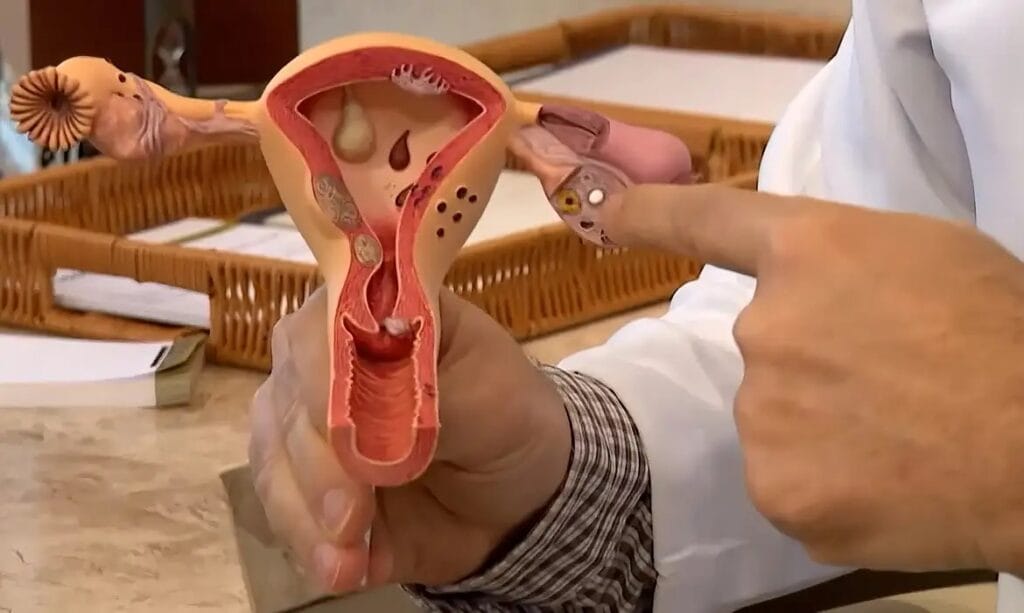Endometriose: conheça os sintomas e saiba como tratar a doença 