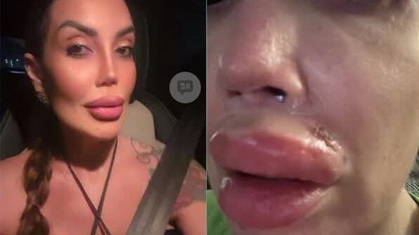 “Príncipe do Lip Lift”: Pacientes denunciam dentista após dentes quebrados, perda de movimentos faciais e internação em UTI