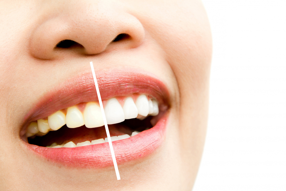 “Receitas da internet” para clarear os dentes podem causar danos irreversíveis