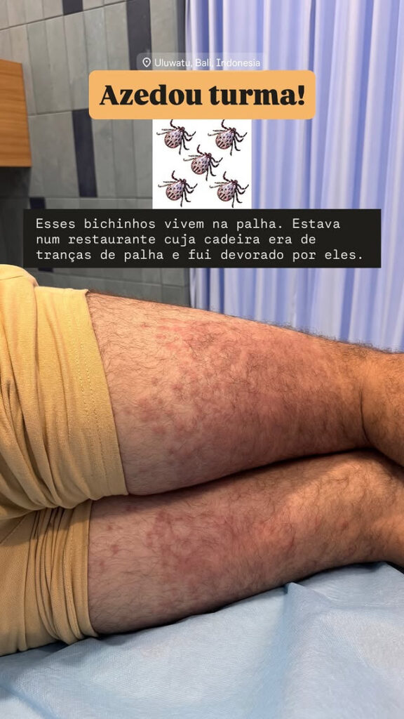 Ex-ator global Lucas Malvacini é hospitalizado na Indonésia após ataque de ácaros de palha