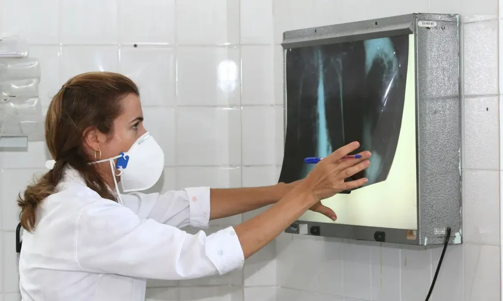 OMS pede ampliação do uso de testes rápidos para acelerar detecção e combate à tuberculose