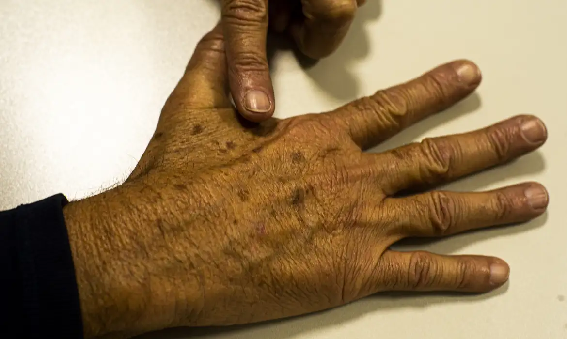 cancer de pele melanoma20220520 0621