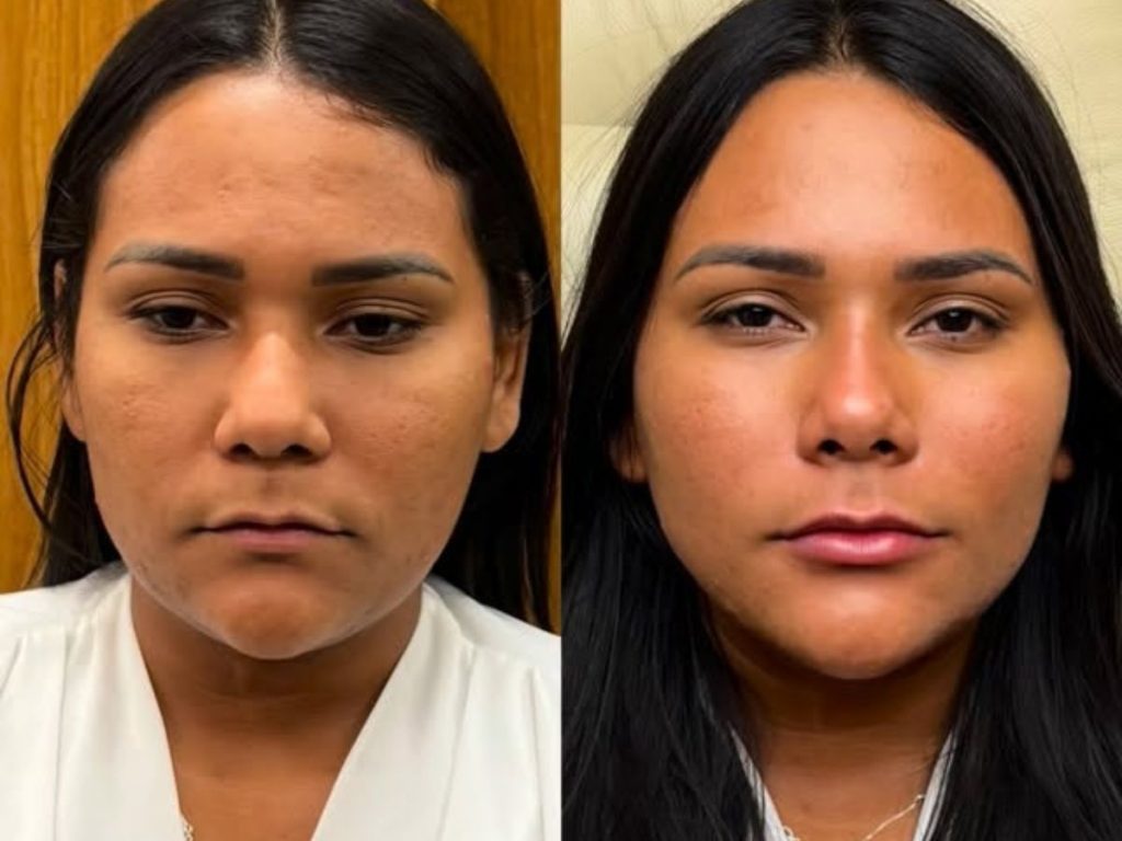 Ex-BBB Chaiany Andrade mostra resultado de harmonização facial e recebe elogios