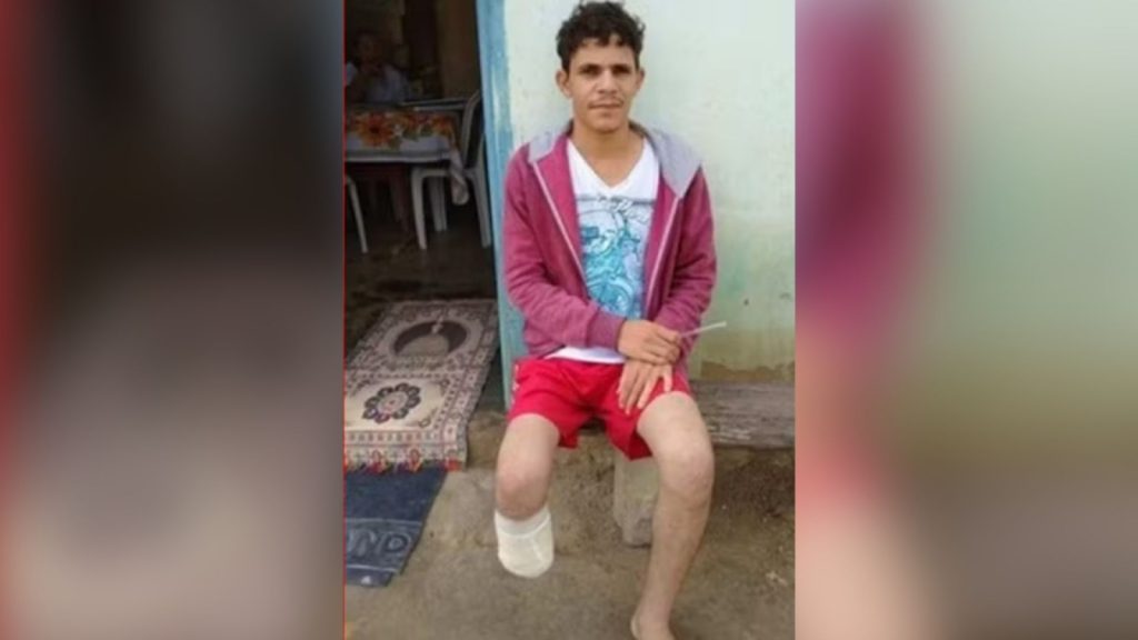 Homem amputa próprio pé para fraudar R$ 1,5 mi em seguros e é condenado
