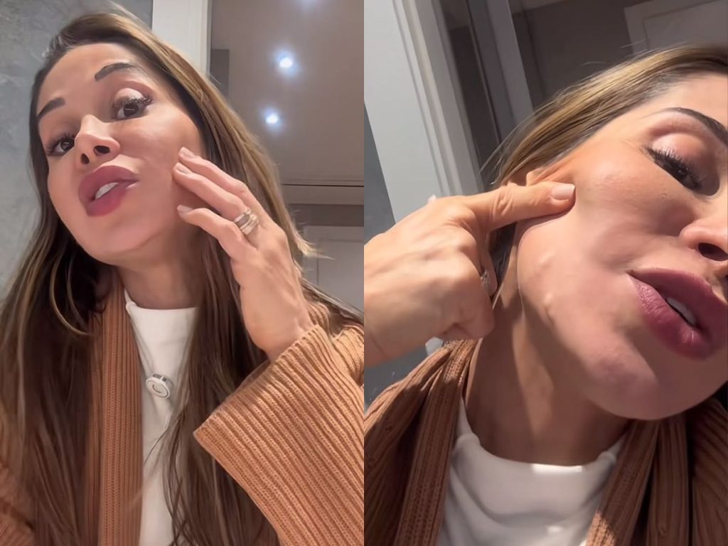 Maíra Cardi exibe lesões no rosto causadas por preenchimento com PMMA