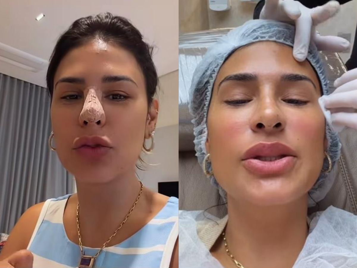 Simone Mendes surge com curativo no nariz e revela tempo de recuperação