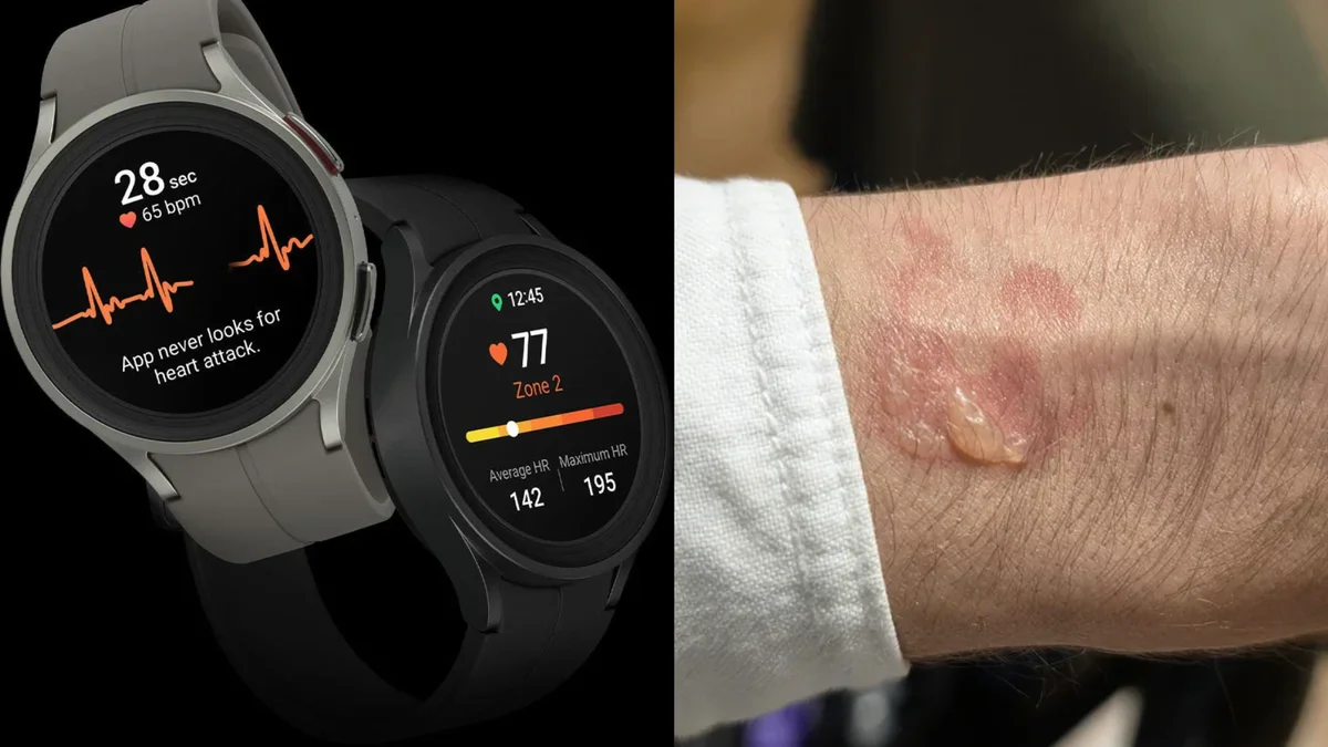 Galaxy Watch provoca queimaduras e superaquecimento à noite
